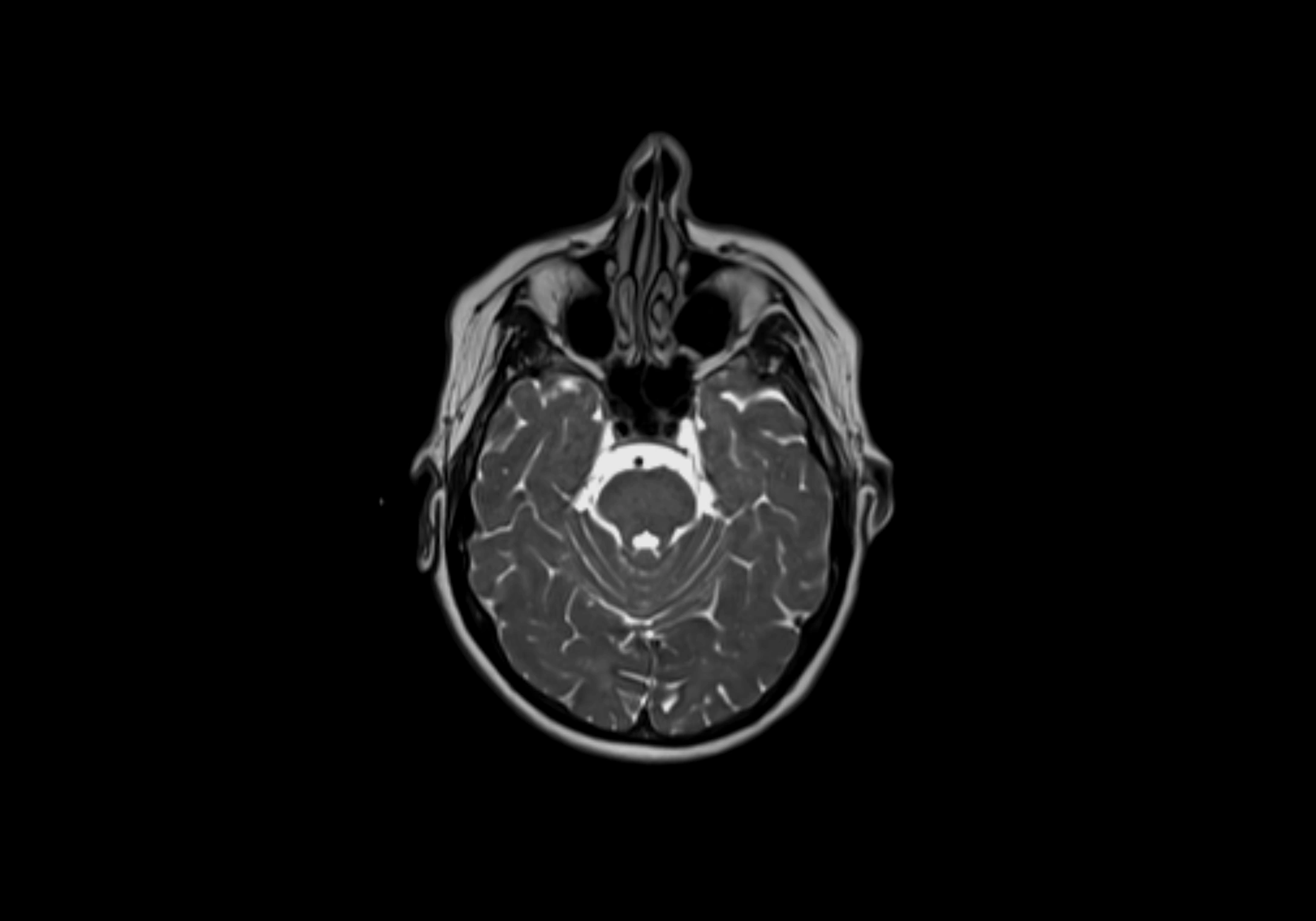 Neck axial  lymph node cross sectional MRI anatomy 3T MRI  image-img-00001-00010.webp